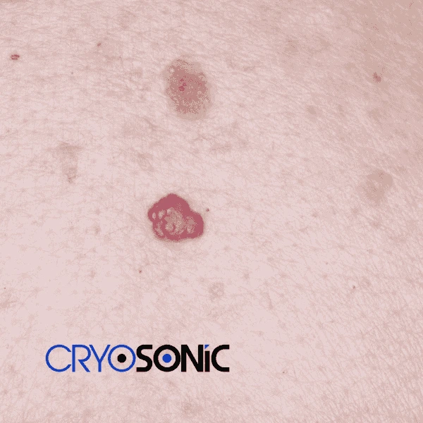 Looking for pain free cherry angioma removal treatment Chelmsford? Call our team today! Chelmsford