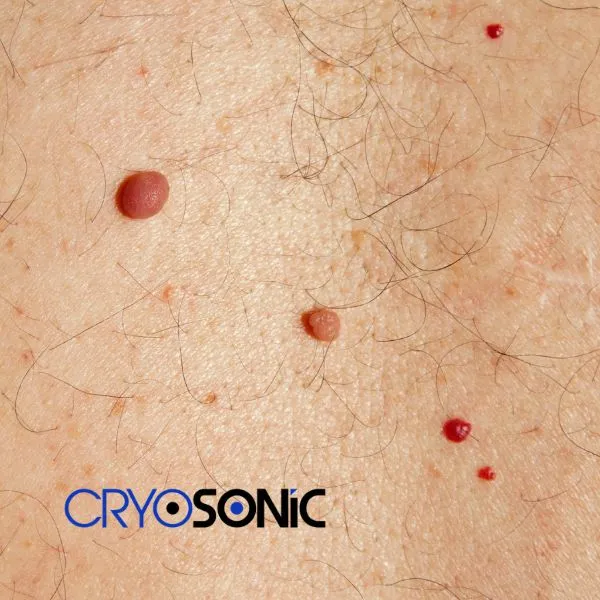 get cherry angioma removal treatment today! Chelmsford