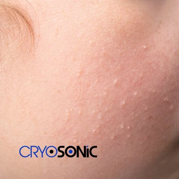 Are you looking for milia removal treatment? Contact our team today Chelmsford