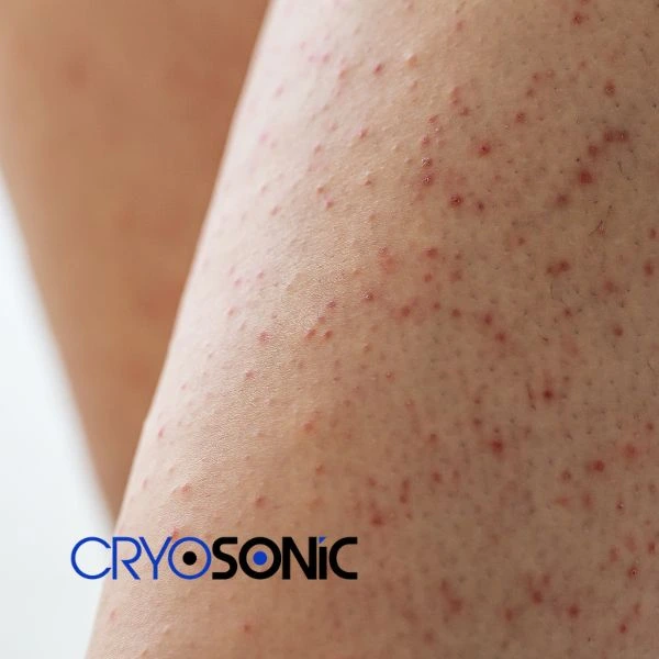 Looking for Seborrhoeic Keratosis removal Chelmsford treatment? Call our consultants today in Chelmsford