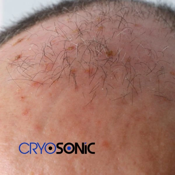 Access Seborrhoeic Keratosis removal from the comfort of your own home! Call us today in Chelmsford