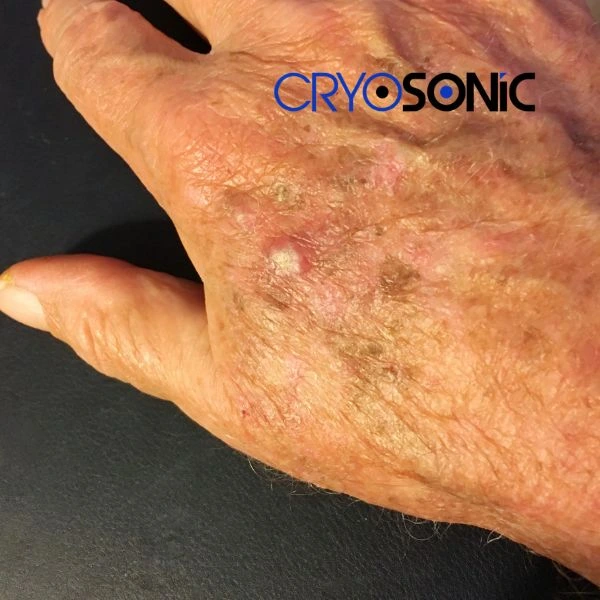 Understand more about actinic keratosis treatment today Chelmsford