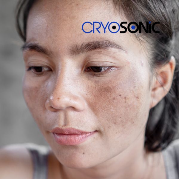 Ready to start age spots removal? Contact our team today in Chelmsford