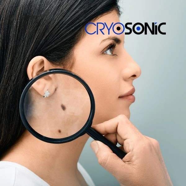 Do you want to learn more about benign moles removal treatment? Call our team today Chelmsford