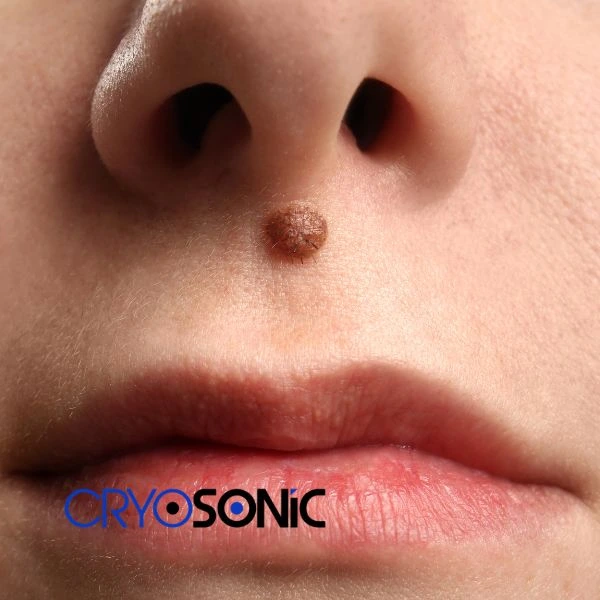 Start your benign moles removal treatment today Chelmsford