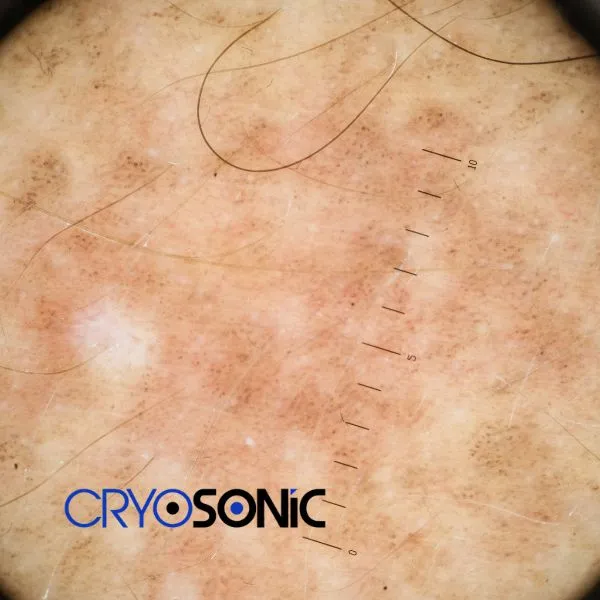 Speak to our team today about sun damaged skin treatment today in Chelmsford