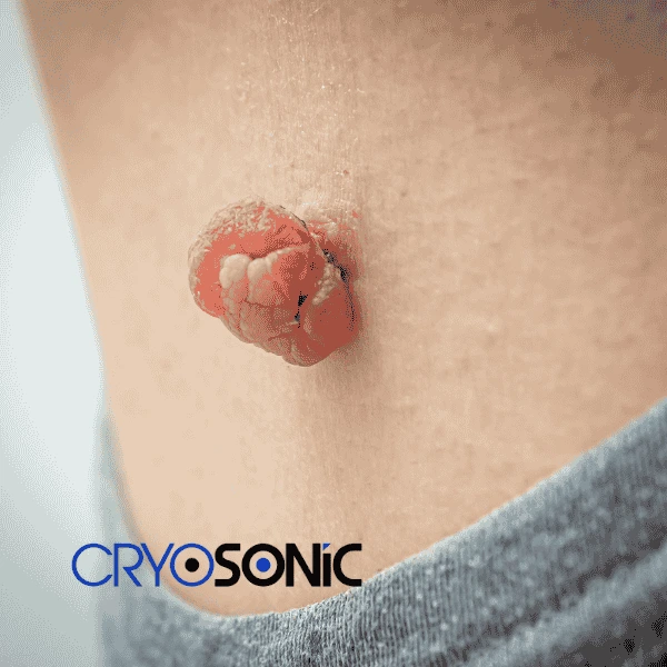 Book your skin tags removal Chelmsford from comfort of your own home! Chelmsford