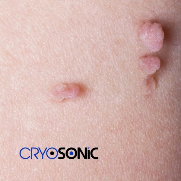 Are you looking for fast effect skin tag removal Chelmsford? Book in NOW! Chelmsford