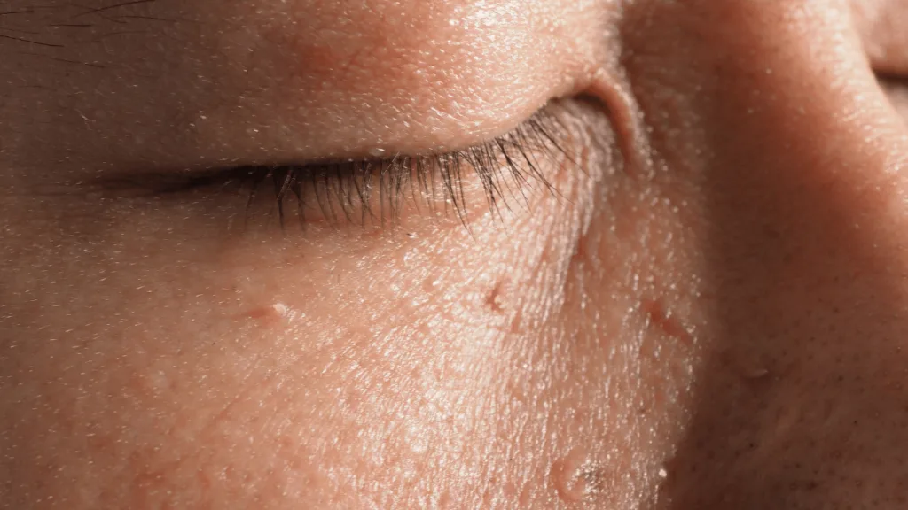 CryoPen removing Skin Tags Chelmsford with precision, showing safe and controlled ablation for smooth, clear skin by Cryosonic Chelmsford