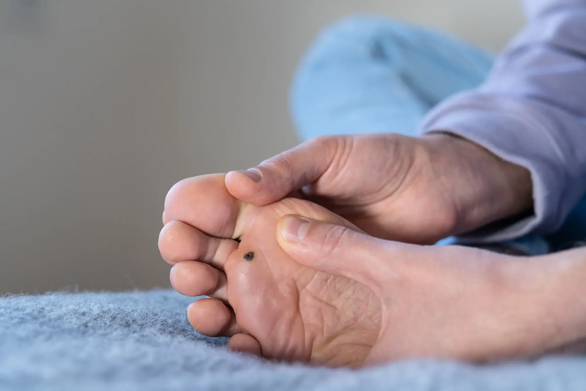 CryoPen treatment for multiple and stubborn Plantar Warts (Verrucae) Chelmsford, showing safe, precise removal and patient-friendly procedure Chelmsford