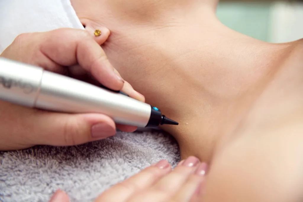 CryoPen precisely treating Molluscum Contagiosum lesions, showing safe and effective removal for faster healing by Cryosonic Chelmsford