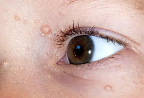 CryoPen treating persistent Molluscum Contagiosum Chelmsford lesions Chelmsford