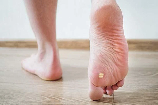 CryoPen treatment removing stubborn Plantar Warts (Verrucae) for precise, safe, and effective relief from resistant lesions Chelmsford