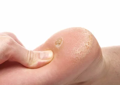 Painful Plantar Warts (Verrucae) Chelmsford, highlighting how stubborn warts affect everyday activities and comfort Chelmsford