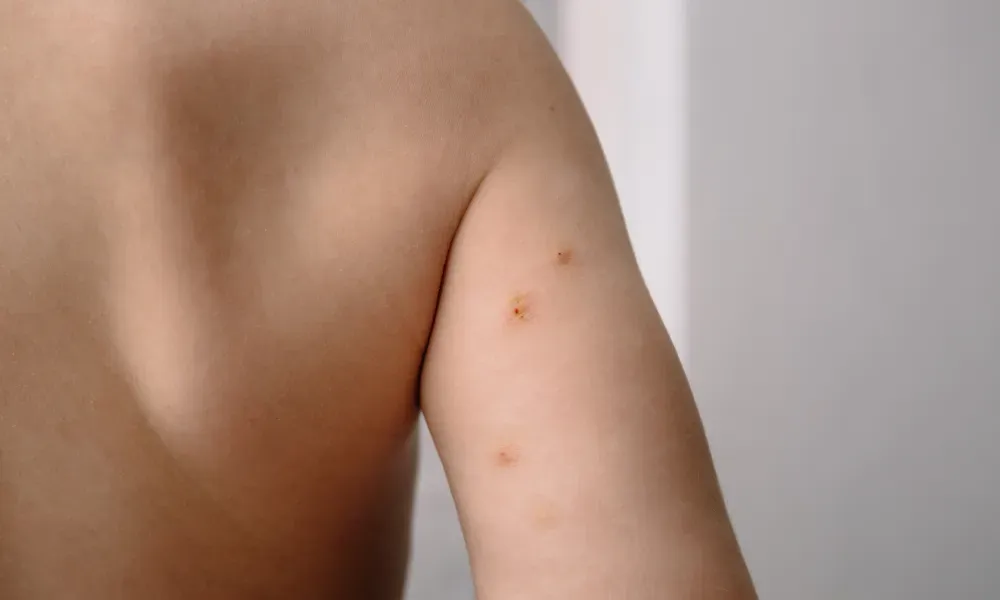 CryoPen treating Molluscum Contagiosum Chelmsford professionally, highlighting safe and precise lesion removal for improved skin and confidence Chelmsford
