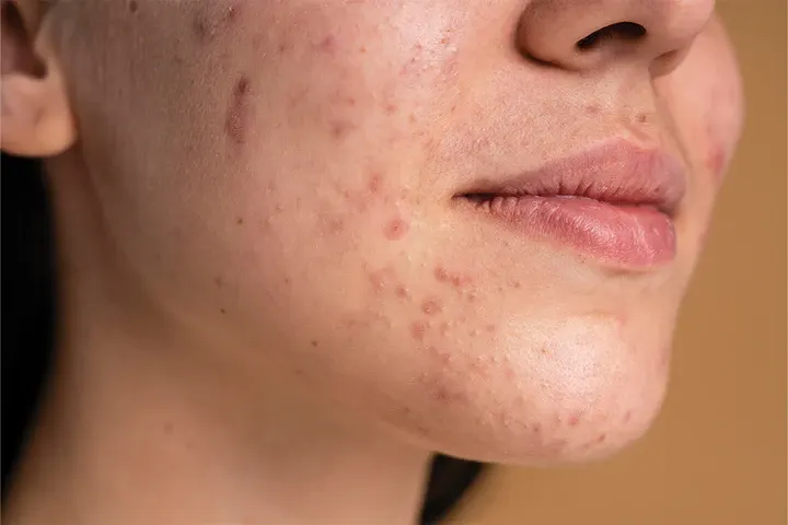 CryoPen precisely removing Skin Tags (fibroepithelial polyps), showing safe and effective treatment for smoother, clearer skin Chelmsford