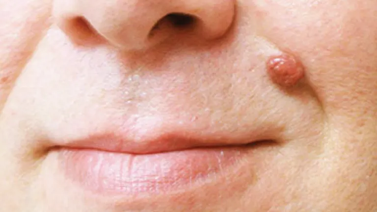 CryoPen safely removing Skin Tags Chelmsford, showing minimal recurrence risk and precise treatment for smoother, clear skin by Cryosonic Chelmsford
