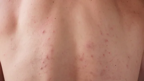 CryoPen treating Chelmsford Molluscum Contagiosum lesions safely and precisely, illustrating answers to common patient FAQs Chelmsford