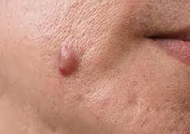 common causes of Skin Tags Chelmsford formation, including friction, genetics, and hormonal changes Chelmsford